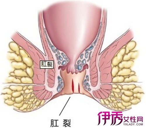 最新肛裂治療方法的研究與應用及其療效評估